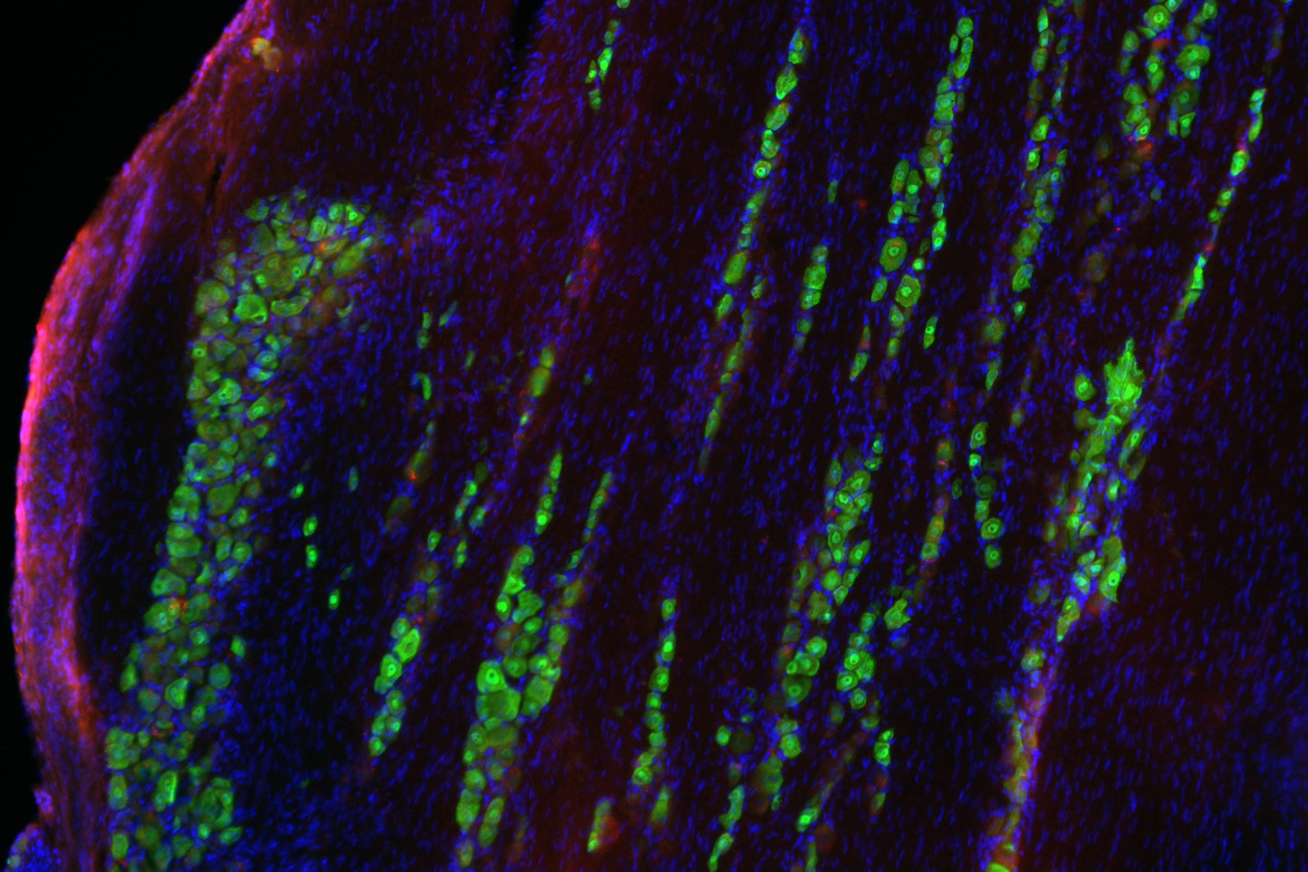 Noninvasive Treatment Boosts Immune Response Against Glioblastoma