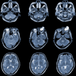 Improving Imaging of the Spinal Cord with Molly Bright, DPhil