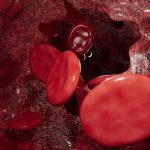 Stents Can Ease Symptoms of Post-Thrombotic Syndrome  