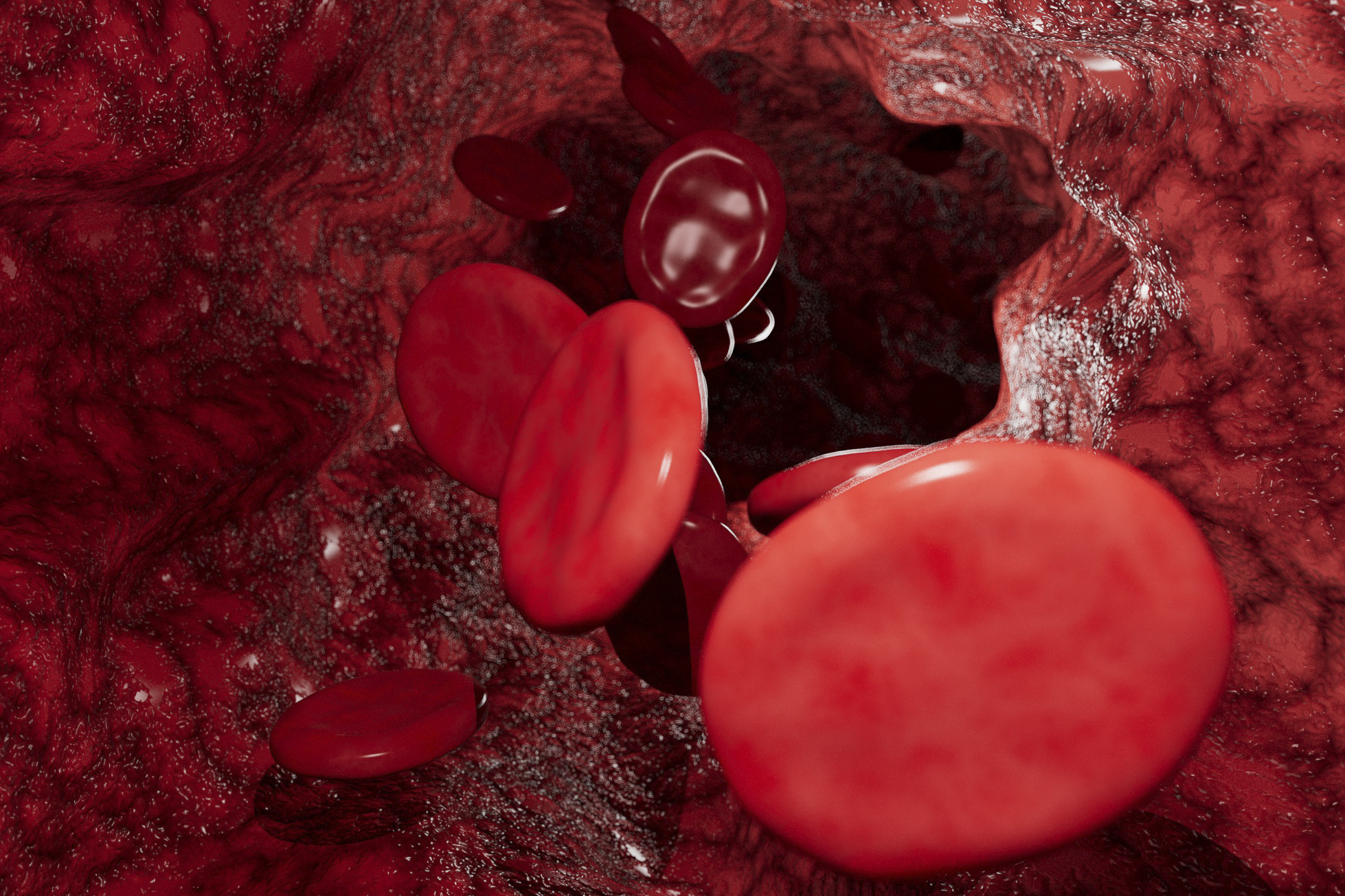Stents Can Ease Symptoms of Post-Thrombotic Syndrome  