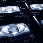 Scans Can Reveal Hidden Prostate Cancer Progression