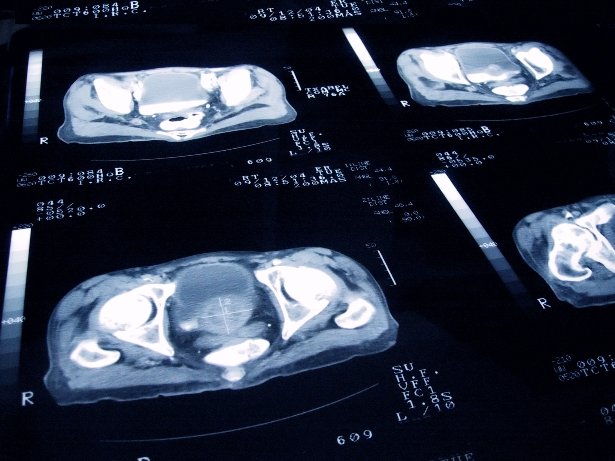 Scans Can Reveal Hidden Prostate Cancer Progression  