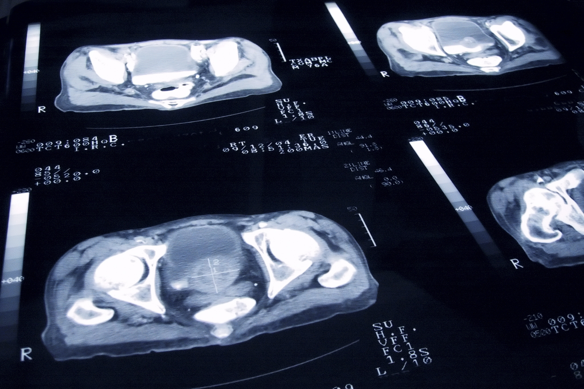 Scans Can Reveal Hidden Prostate Cancer Progression