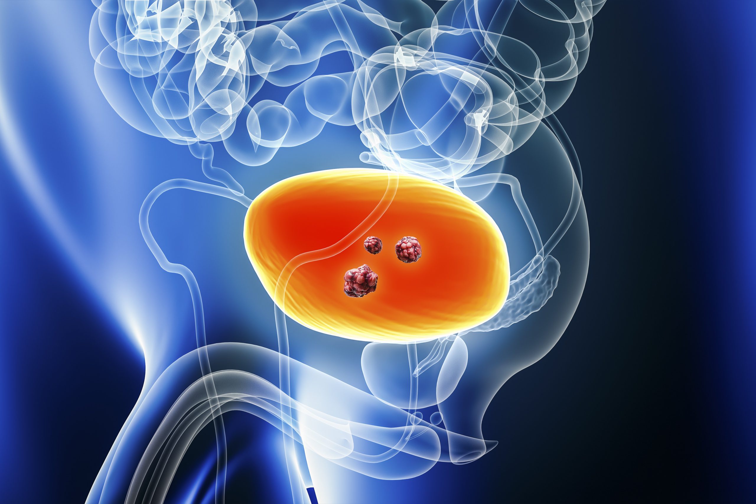 Understanding Treatment Response in High-Risk Bladder Cancer 