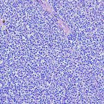 Immunotherapy Shows Long-Term Promise in Aggressive Lymphoma