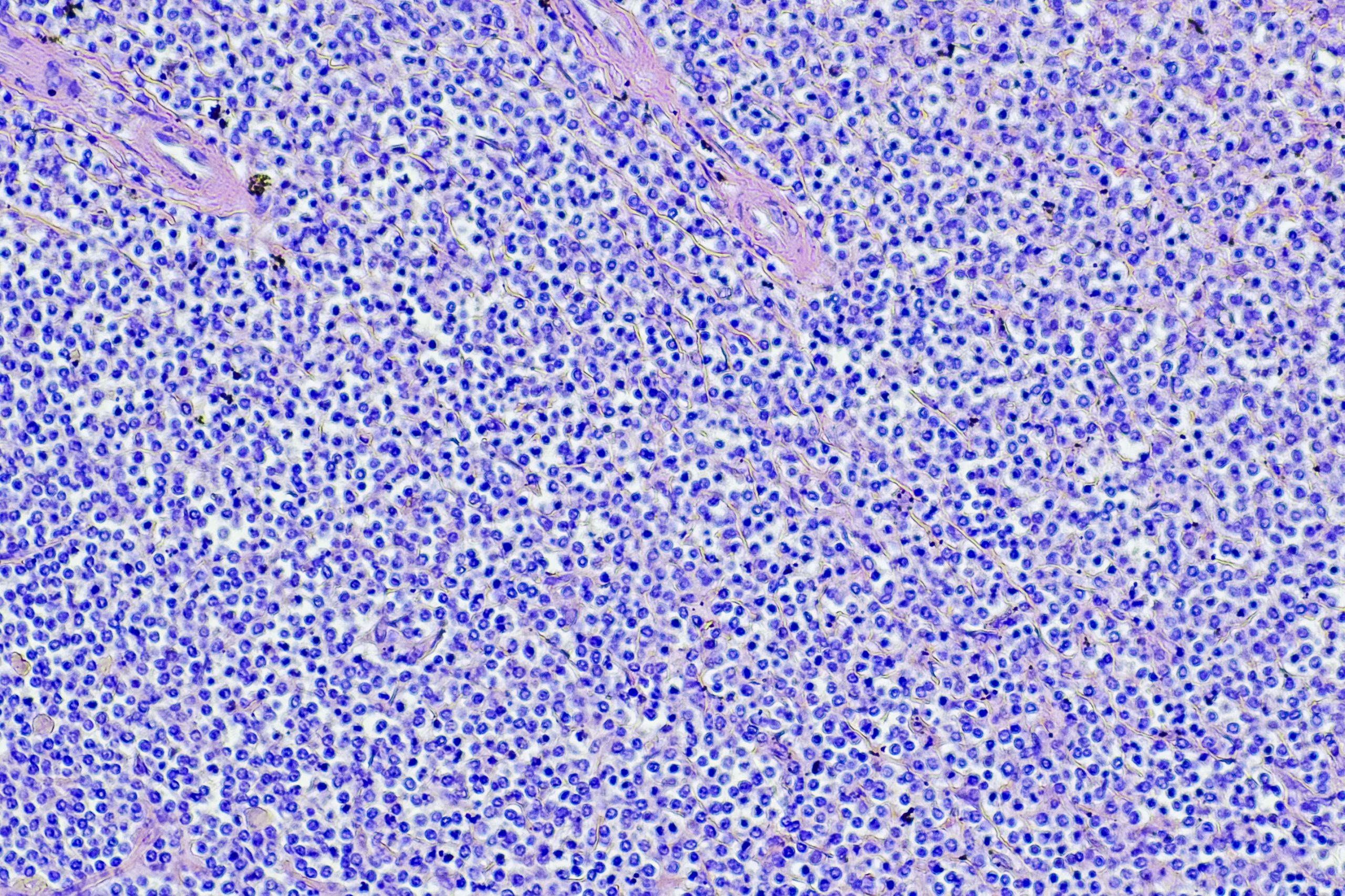 Immunotherapy Shows Long-Term Promise in Aggressive Lymphoma