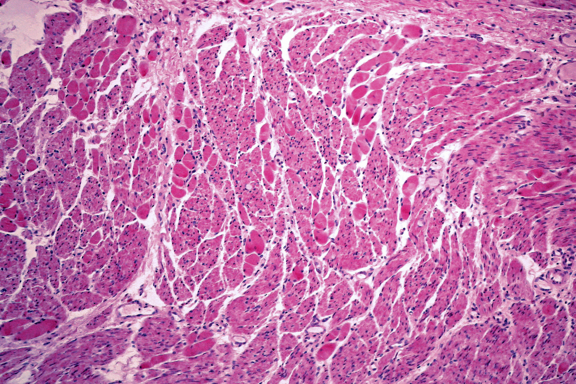 New Cellular Clues to Complications of Scleroderma
