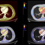 Imaging Agent May Improve Diagnoses for Rare Heart Disease