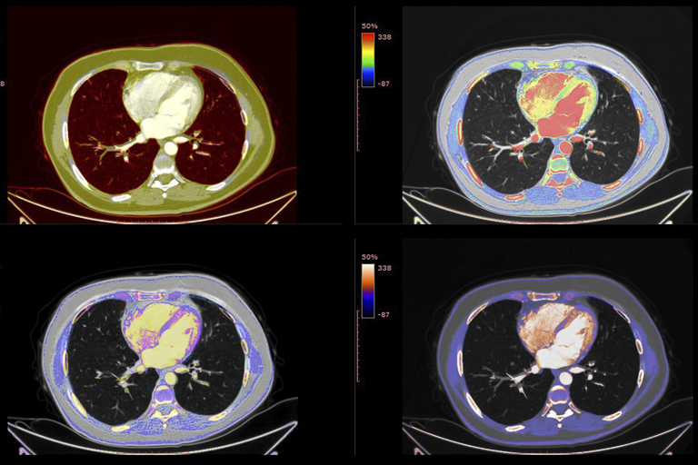 Imaging Agent May Improve Diagnoses for Rare Heart Disease