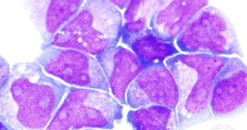 Inhibitor May Help Treat Acute Myeloid Leukemia