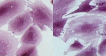 Scientists Publish Finding on Cause, Progression of Endometriosis