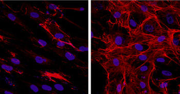 New Clues on Tissue Scarring in Scleroderma
