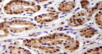 Uncovering Similarities Between Prostate Cancer Genomes