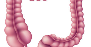 Study Helps Explain Chronic Inflammation in Colon Cancer