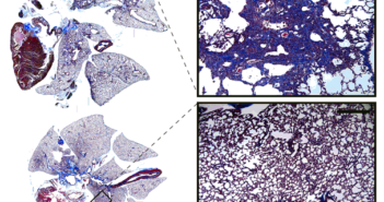 Pathway Found for Treating Fatal Lung Disease