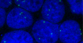 New Understanding of Cystic Fibrosis Gene Expression