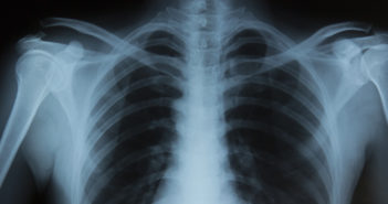 Novel Drug May Increase Bone Growth in Children with Achondroplasia