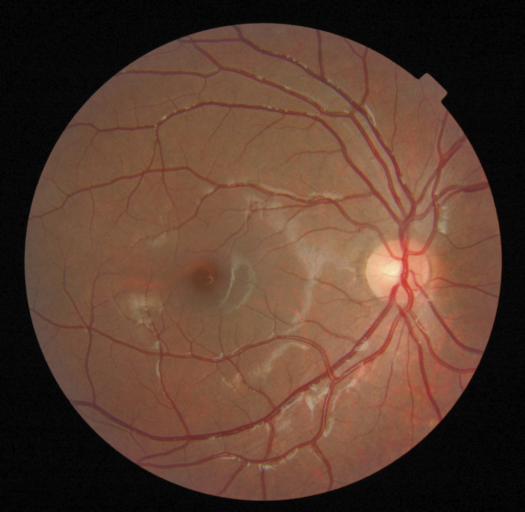 Evaluating Drugs to Improve Vision In Diabetic Macular Edema - News Center