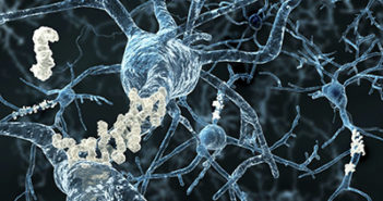Alzheimer’s Treatment Holds Promise for Primary Progressive Aphasia Patients