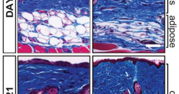 Fat Tissue May Be Key to Scleroderma’s Progression
