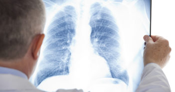 Estimating the Burden of Pneumonia Hospitalizations