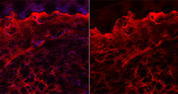 Mechanism Behind Chronic Fibrosis Discovered