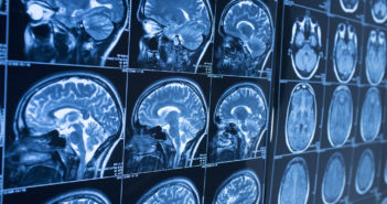 Examining Rare Neurological Complications of COVID-19 in Children