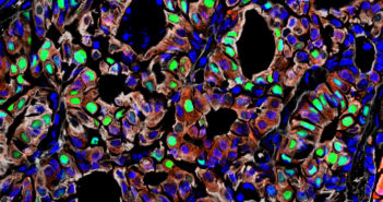 Pinpointing the Origins of Prostate Cancer