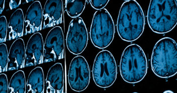Innovative Imaging Approach Uncovers Pathway Changes After Stroke