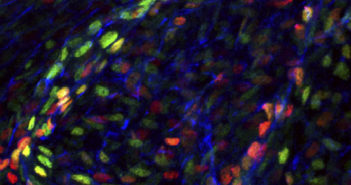 Scientists Identify Mutations in Venous Valve Disease