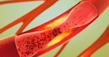 Stem Cells Fail to Alleviate Peripheral Artery Disease
