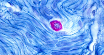 Chemotherapy Drug Mitigates Allergic Response