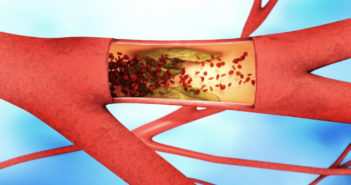 A Wearable Device Intervention to Increase Exercise in Peripheral Artery Disease