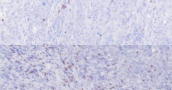 Rare Bacteria Boosts Immunotherapy in Prostate Cancer cp1