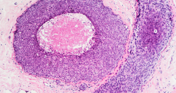 Overexpression of Enzyme Increases Risk of Treatment Failure in Breast Cancer