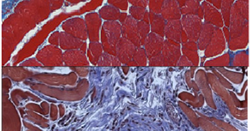 Rising Estrogen Levels May Cause Common Men’s Hernias