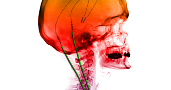 Steadying the Symptoms of Parkinson’s Disease