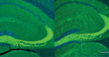 Alzheimer’s Drug Shows Promise, But Risk Remains