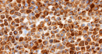 Study Finds Critical Genes for Viral Lymphoma