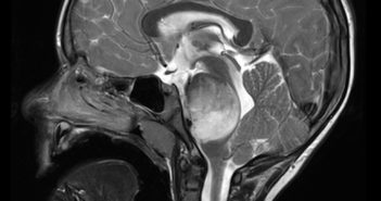 New Biomarkers for Glioma Treatment Response