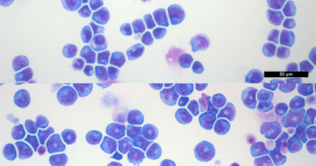 New Regulator of Leukemia Discovered