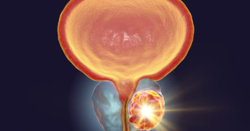 Study Suggests New Strategy to Treat Advanced Prostate Cancer