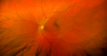Eyes May Reveal Early Alzheimer’s Disease