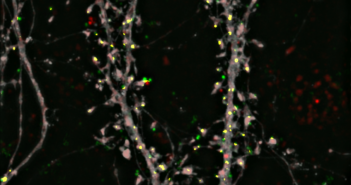 Mechanism Behind Sporadic Alzheimer’s Gene Discovered