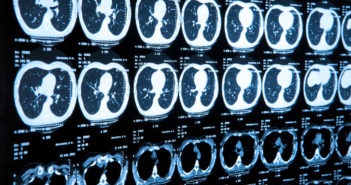 Artificial Intelligence System Spots Lung Cancer Before Radiologists