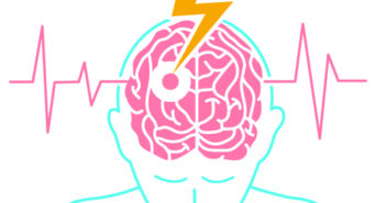 Patients Need Monitoring for Atrial Fibrillation After Ischemic Stroke