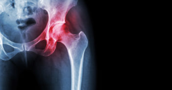 Drug Shows Benefit for Osteoarthritis Patients
