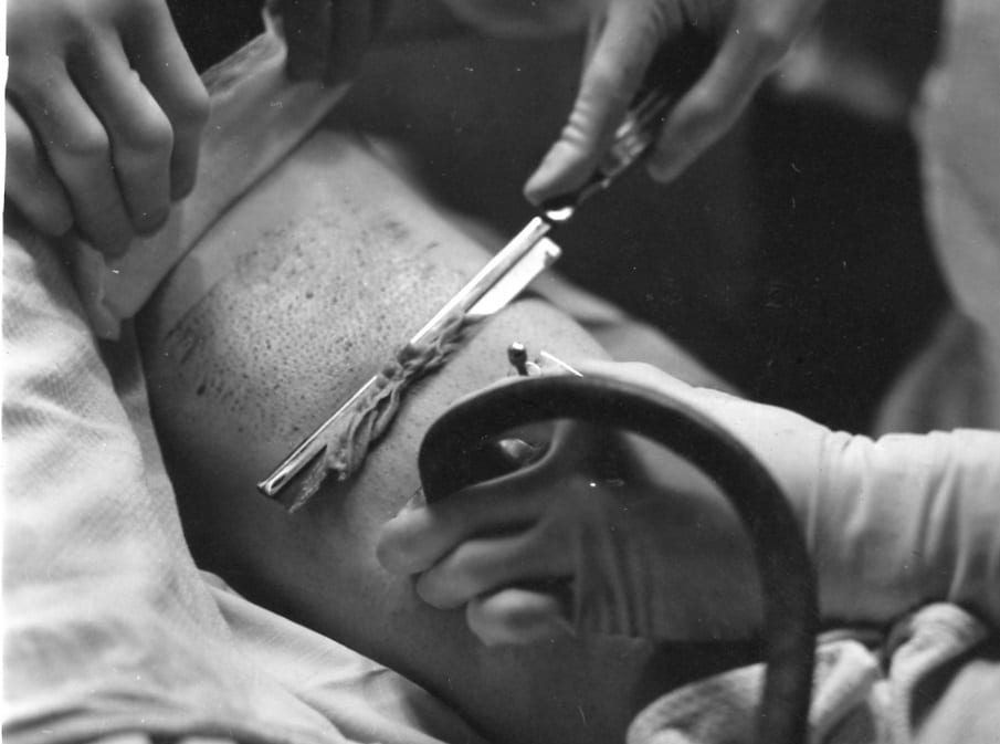 A skin graft in process.