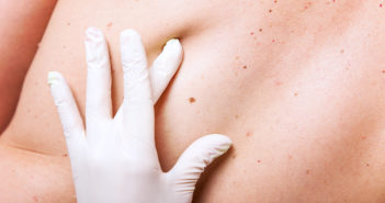 Dangerous Skin Tumor Now Has Treatment Guidelines