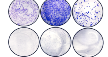 New Drug Target for Treatment-Resistant Prostate Cancer